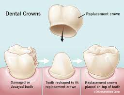 Illustration of Dental Crowns, Crowns & Bridges, Maitland, FL
